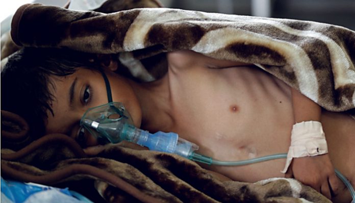 An eight-year-old malnourished boy lies on a bed in the emergenc